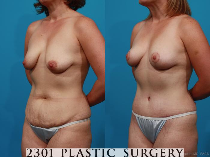Before & After Breast Lift (Mastopexy) Case 237 View #5 View in Fort Worth, Plano, & Frisco, Texas