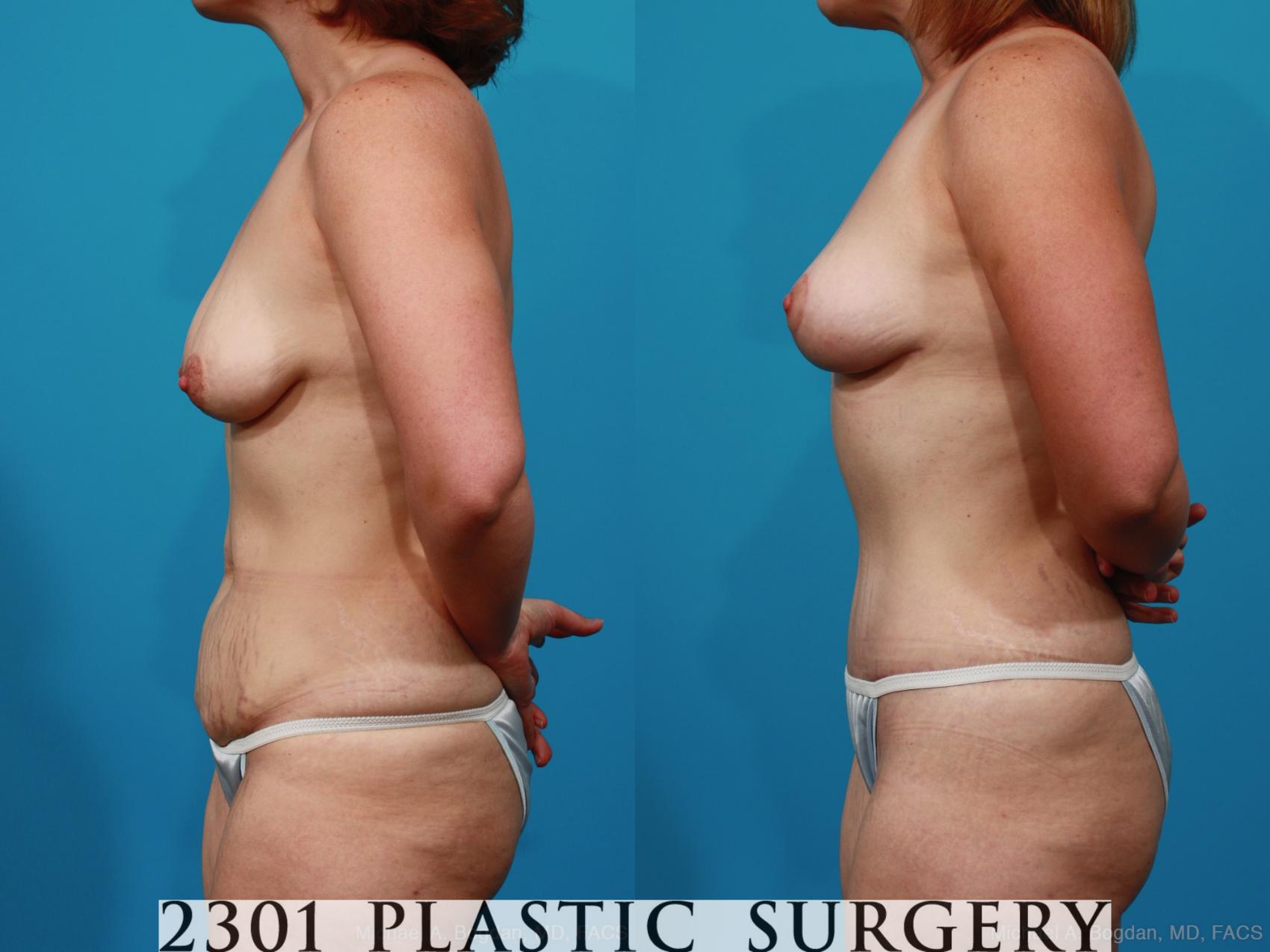 Before & After Mommy Makeover Case 237 View #6 View in Fort Worth & Frisco, Texas