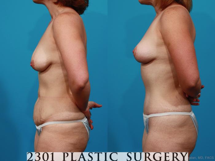 Before & After Breast Lift (Mastopexy) Case 237 View #6 View in Fort Worth, Plano, & Frisco, Texas