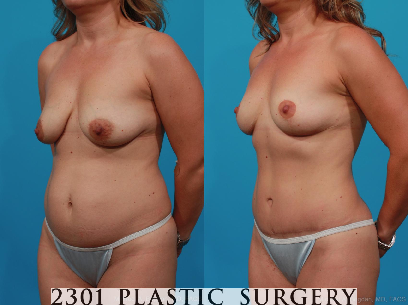 Before & After Mommy Makeover Case 245 View #3 View in Fort Worth & Frisco, Texas