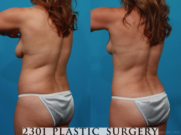Before & After Tummy Tuck Case 245 View #4 View in Fort Worth & Frisco, Texas
