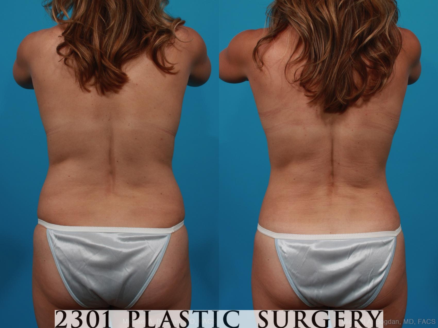 Before & After Mommy Makeover Case 245 View #5 View in Fort Worth & Frisco, Texas