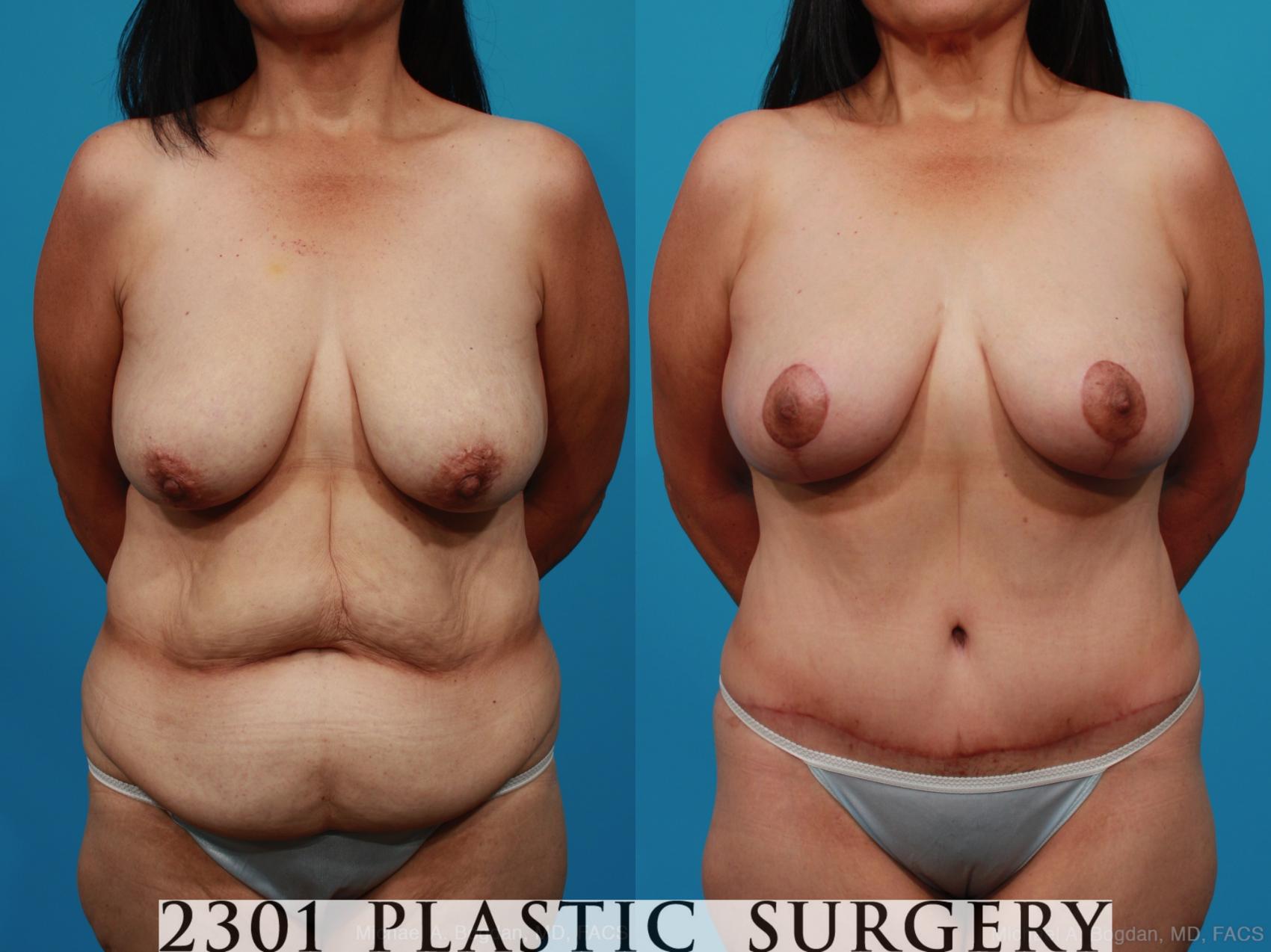 Before & After Breast Lift (Mastopexy) Case 252 View #1 View in Fort Worth, Plano, & Frisco, Texas