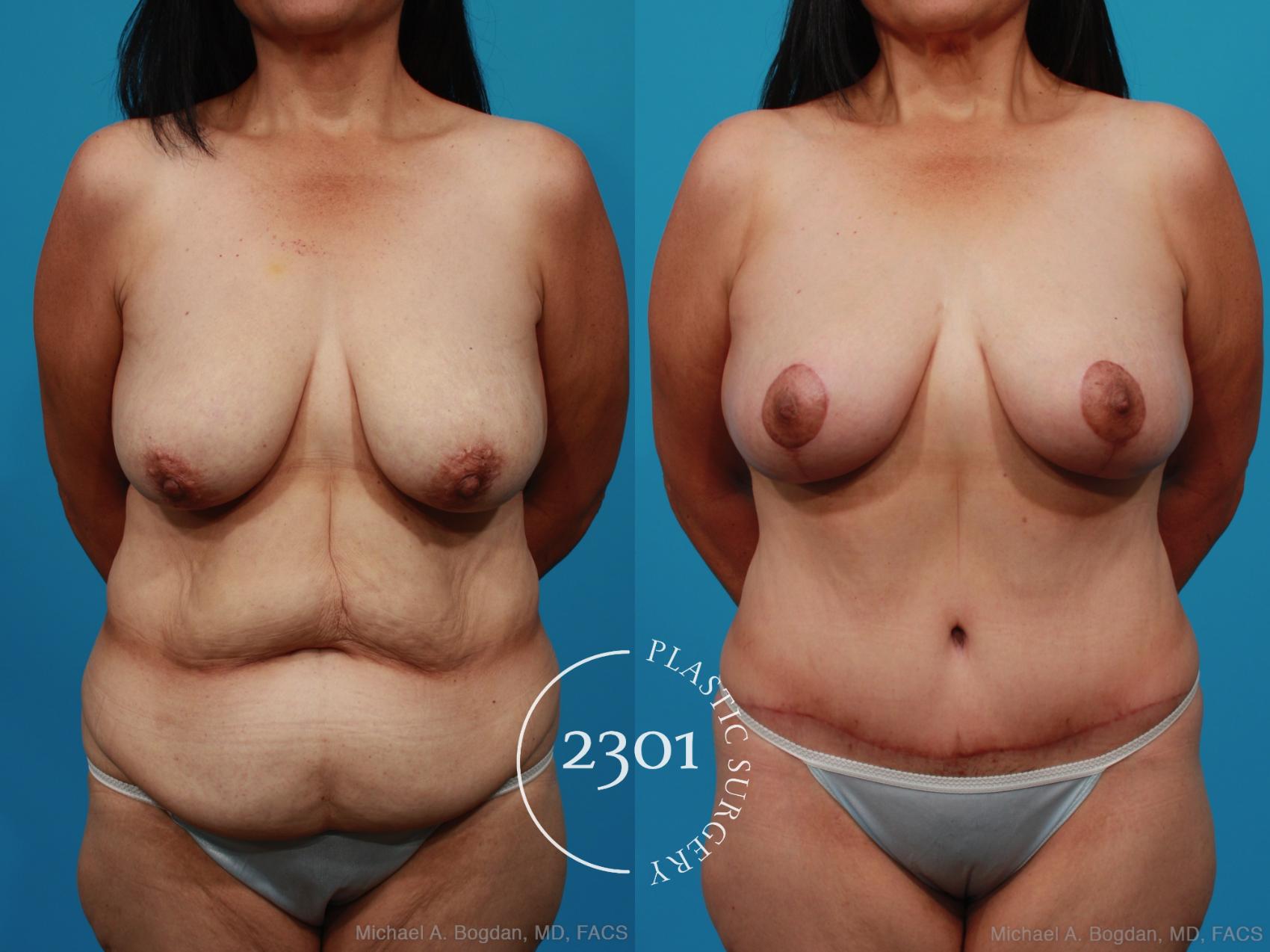 Before & After Breast Lift (Mastopexy) Case 252 View #1 View in Fort Worth, Plano, & Frisco, Texas