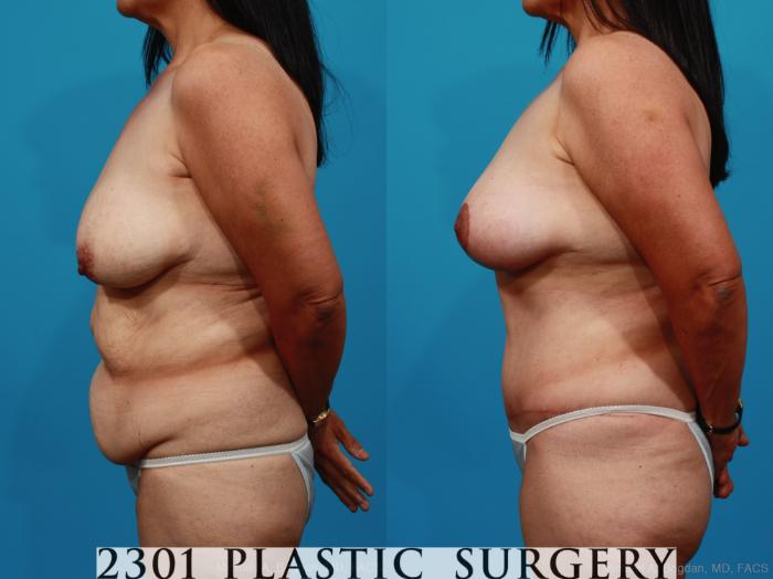 Before & After Mommy Makeover Case 252 View #2 View in Fort Worth, Plano, & Frisco, Texas