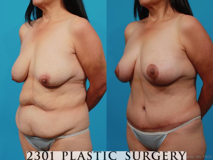 Before & After Mommy Makeover Case 252 View #3 View in Fort Worth, Plano, & Frisco, Texas