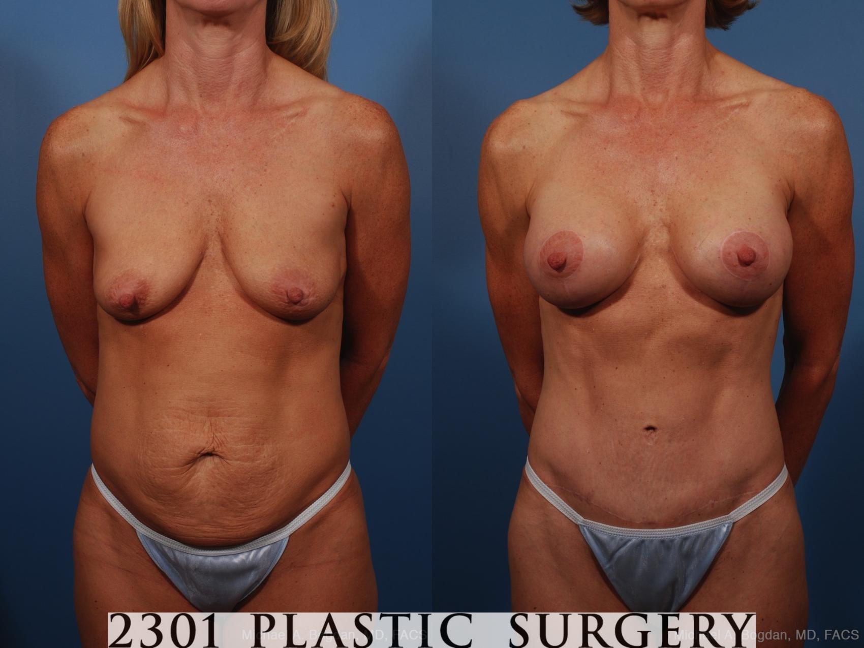 Before & After Mommy Makeover Case 259 View #1 View in Fort Worth & Frisco, Texas
