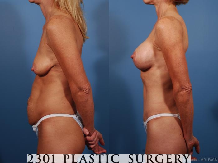 Before & After Silicone Implants Case 259 View #2 View in Fort Worth, Plano, & Frisco, Texas