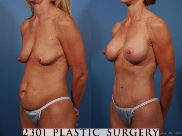 Before & After Mommy Makeover Case 259 View #3 View in Fort Worth, Plano, & Frisco, Texas