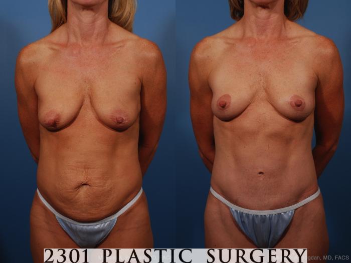 Before & After Breast Lift (Mastopexy) Case 259 View #4 View in Fort Worth, Plano, & Frisco, Texas