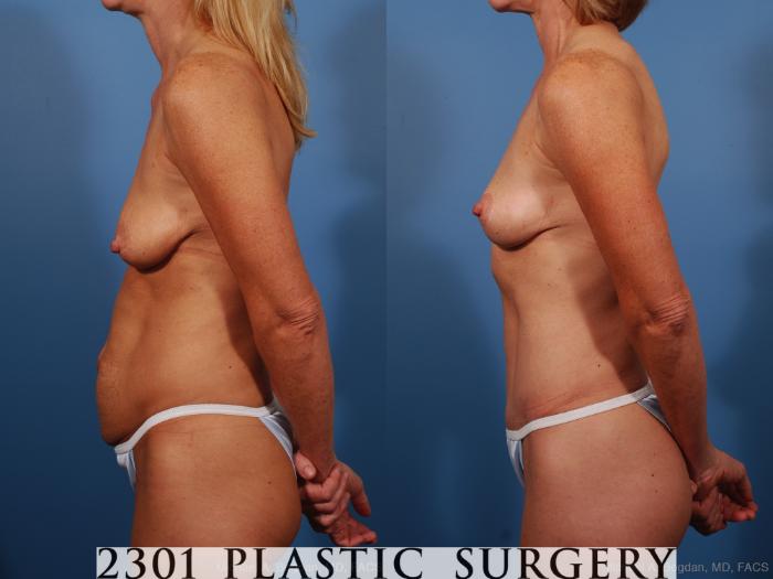 Before & After Breast Lift (Mastopexy) Case 259 View #5 View in Fort Worth, Plano, & Frisco, Texas