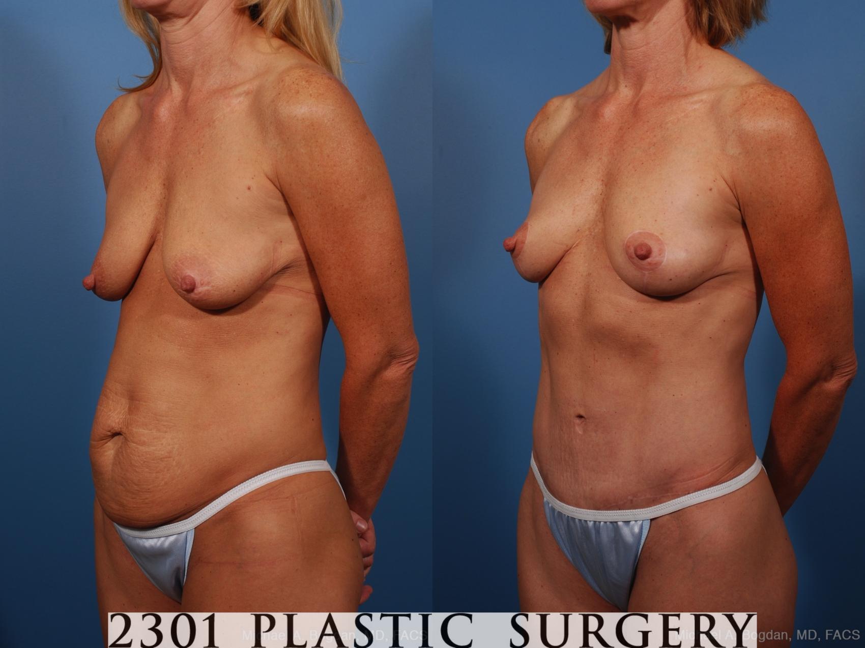Before & After Mommy Makeover Case 259 View #6 View in Fort Worth & Frisco, Texas