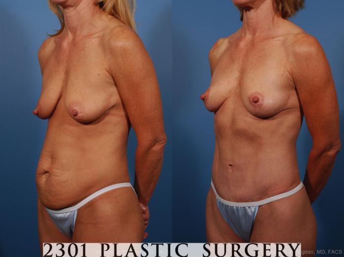 Before & After Breast Augmentation Case 259 View #6 View in Fort Worth, Plano, & Frisco, Texas