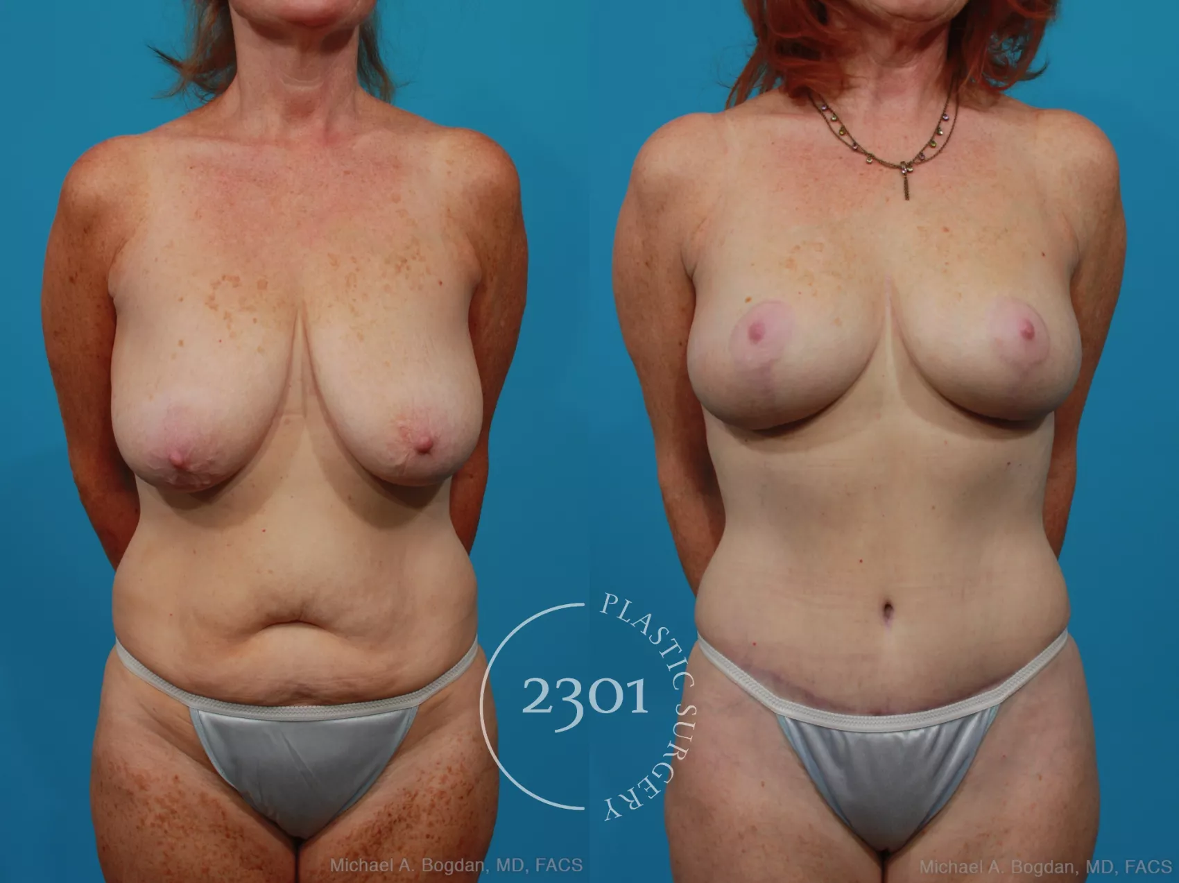 Before & After Mommy Makeover Case 265 View #1 View in Fort Worth, Plano, & Frisco, Texas