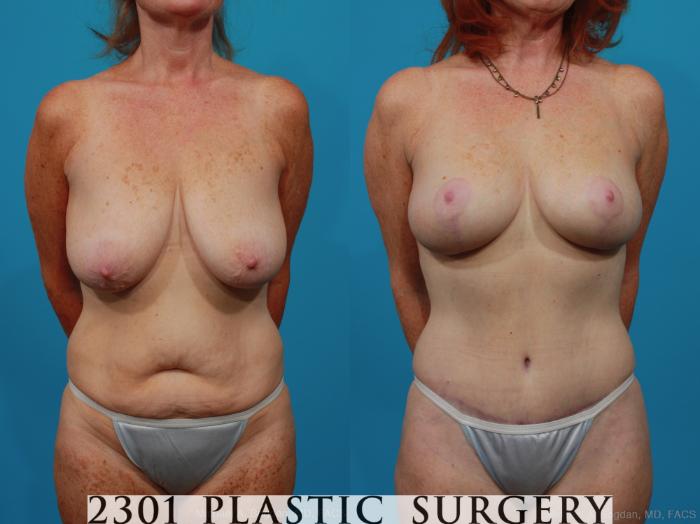 Before & After Liposuction Case 265 View #1 View in Fort Worth & Frisco, Texas