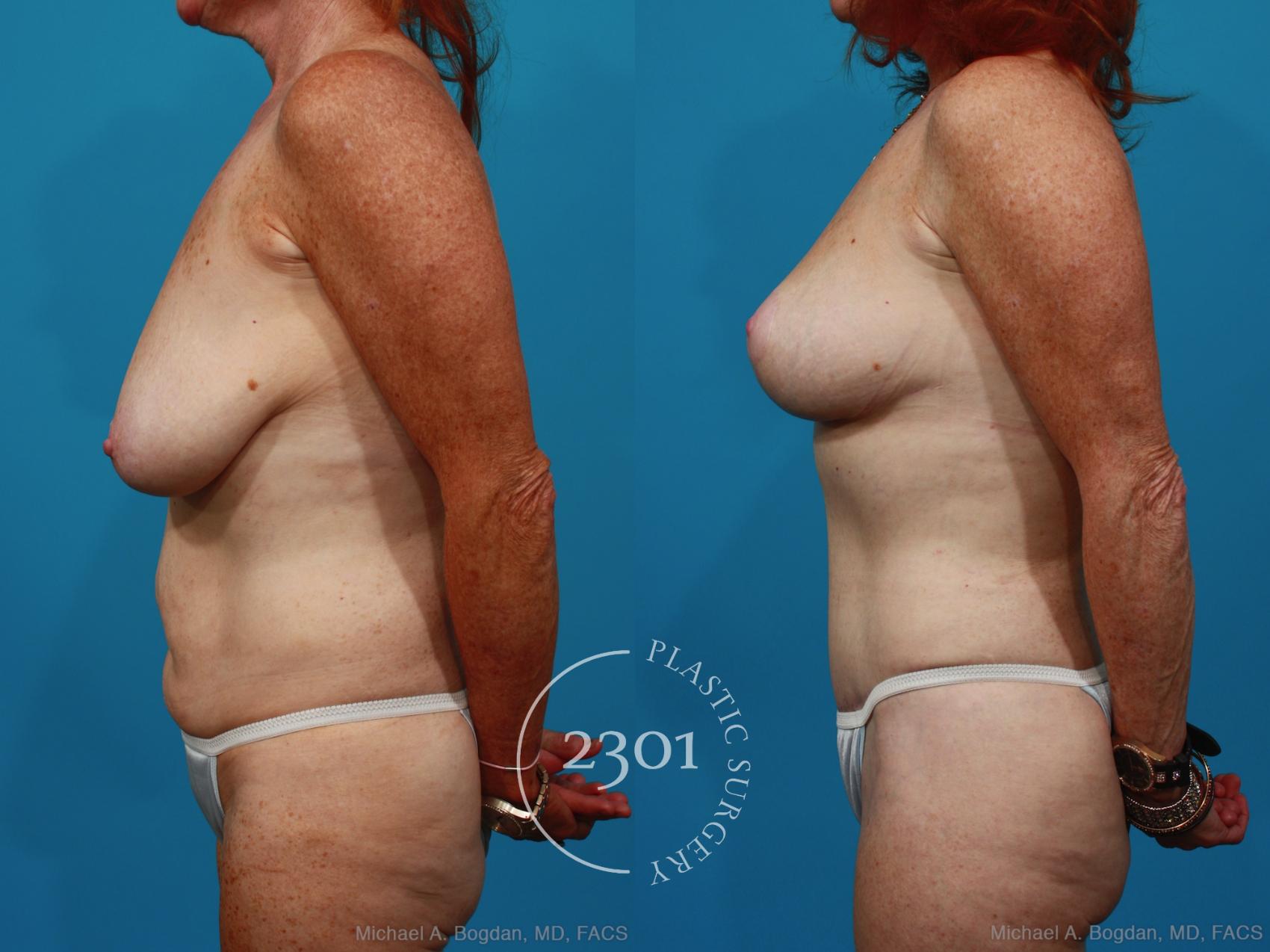 Before & After Mommy Makeover Case 265 View #2 View in Fort Worth, Plano, & Frisco, Texas