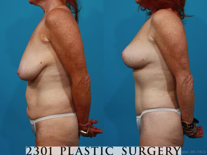 Before & After Mommy Makeover Case 265 View #2 View in Fort Worth & Frisco, Texas