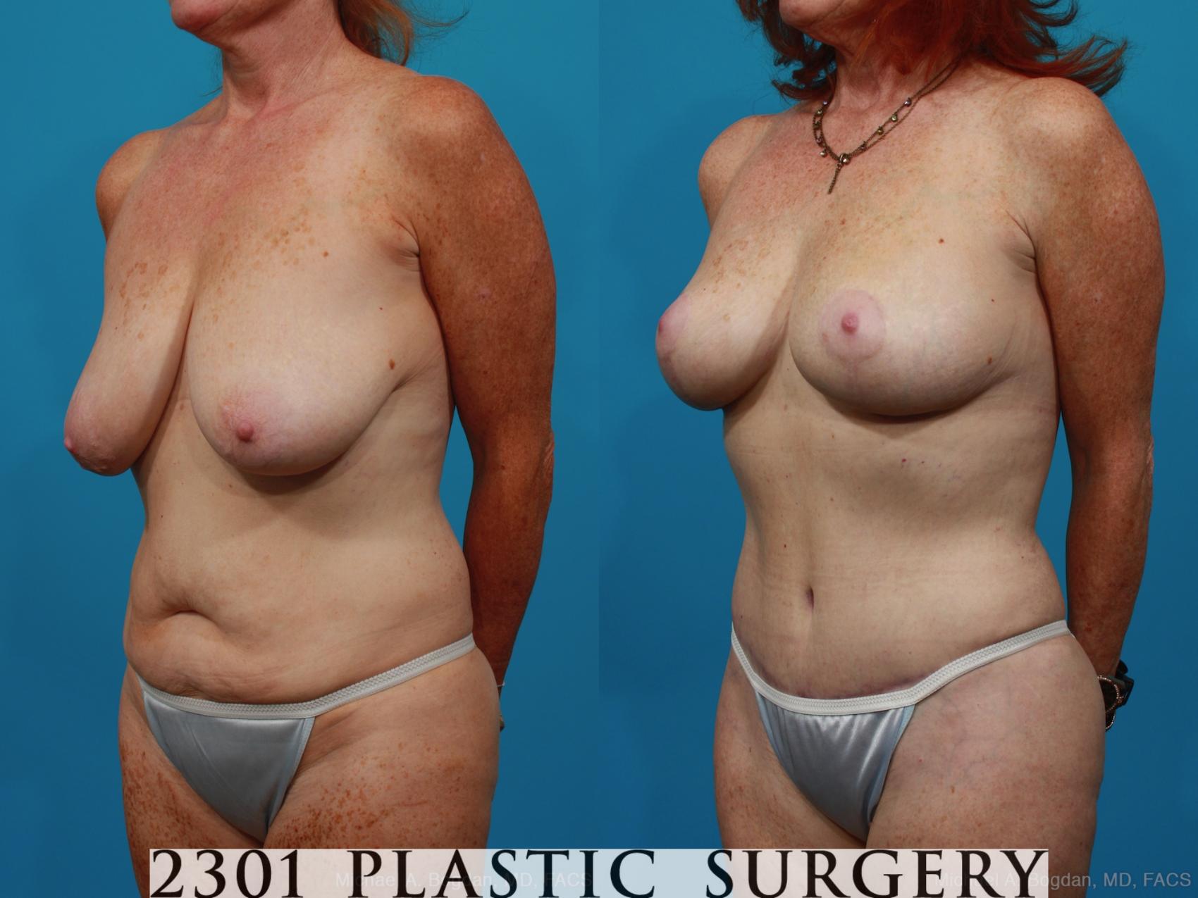 Before & After Mommy Makeover Case 265 View #3 View in Fort Worth, Plano, & Frisco, Texas