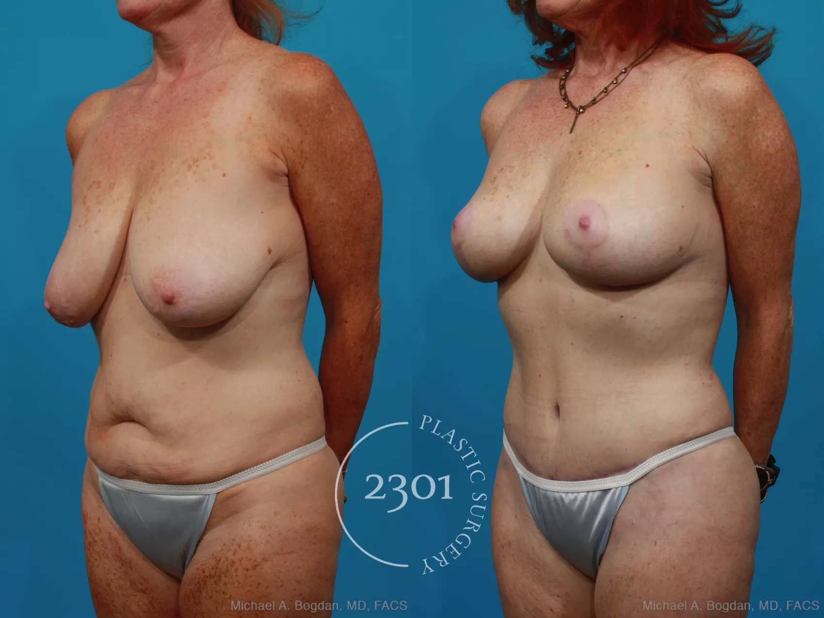 Before & After Mommy Makeover Case 265 View #3 View in Fort Worth, Plano, & Frisco, Texas