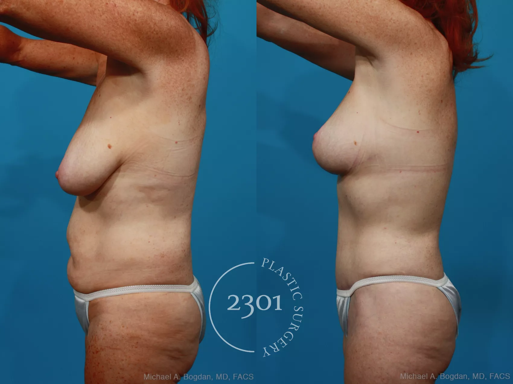 Before & After Mommy Makeover Case 265 View #4 View in Fort Worth, Plano, & Frisco, Texas