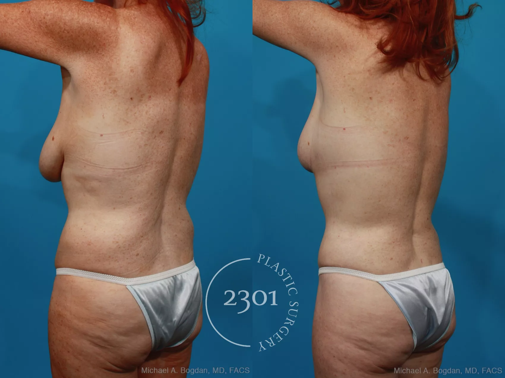Before & After Mommy Makeover Case 265 View #5 View in Fort Worth, Plano, & Frisco, Texas