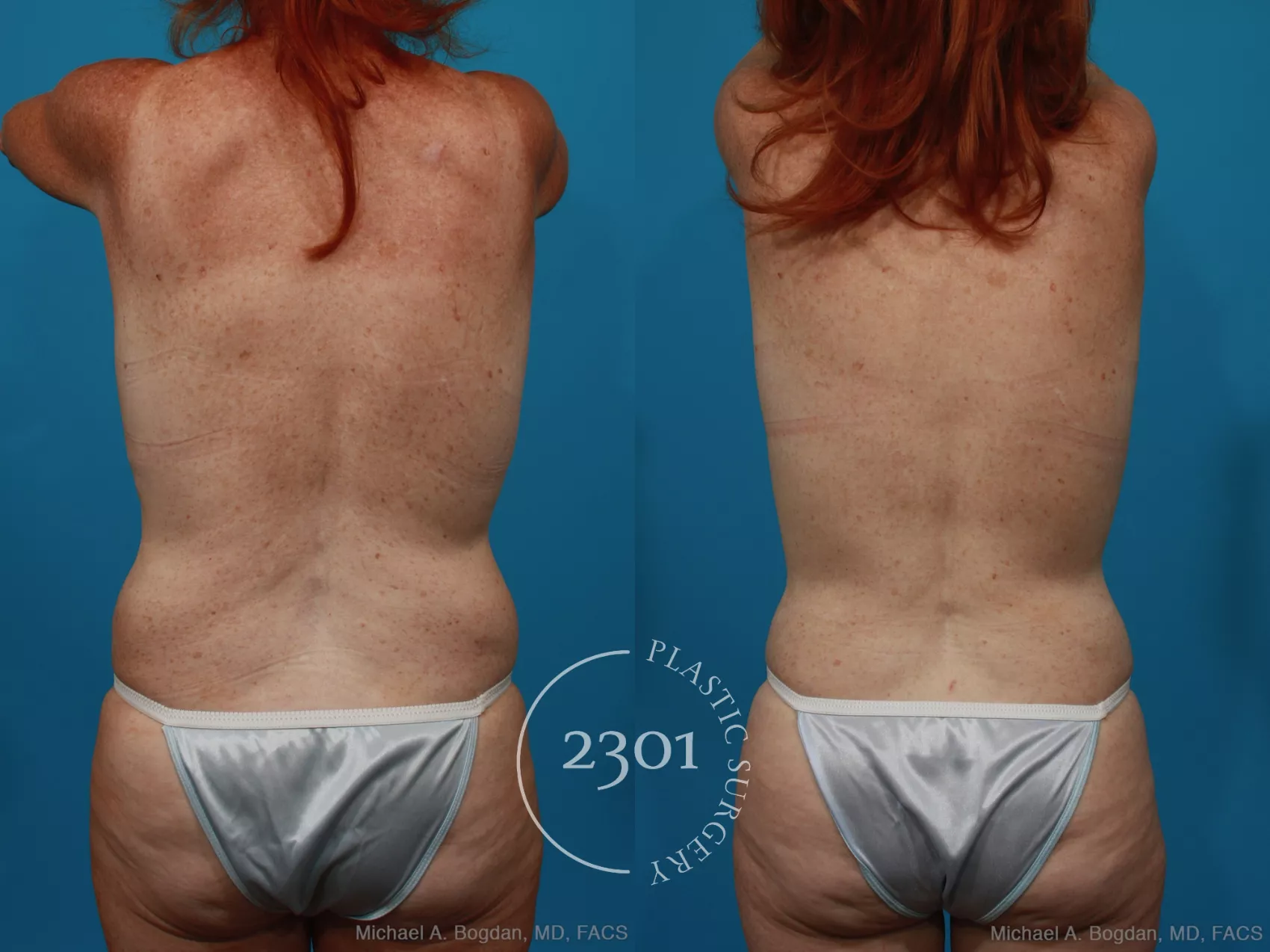 Before & After Mommy Makeover Case 265 View #6 View in Fort Worth, Plano, & Frisco, Texas