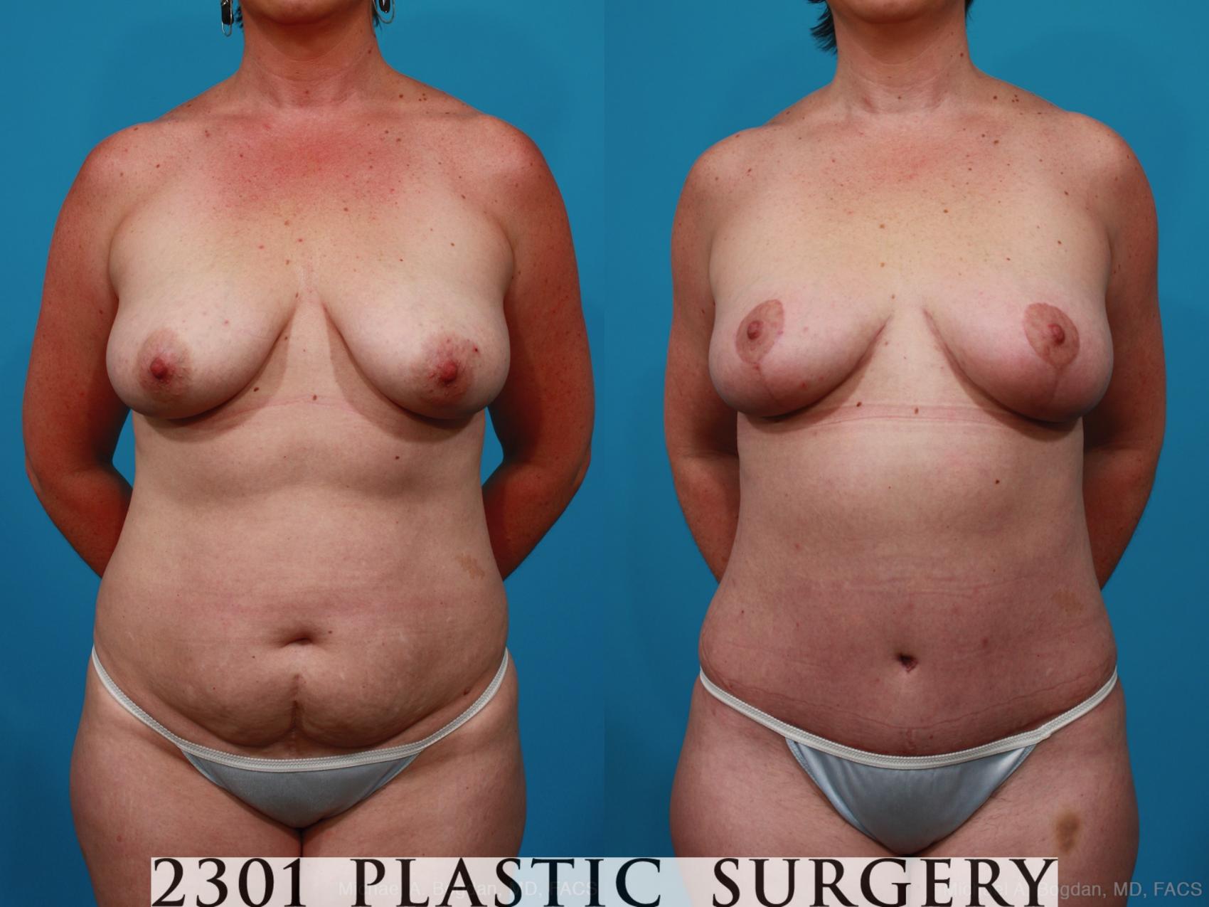 Before & After Breast Lift (Mastopexy) Case 266 View #1 View in Fort Worth & Frisco, Texas