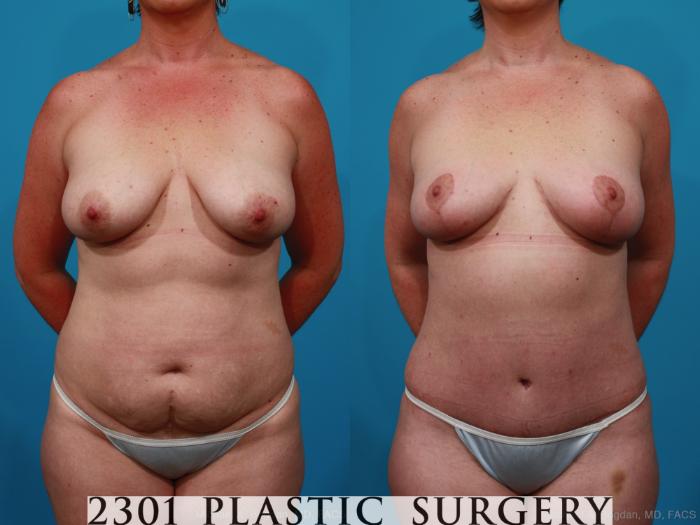 Before & After Tummy Tuck Case 266 View #1 View in Fort Worth & Frisco, Texas
