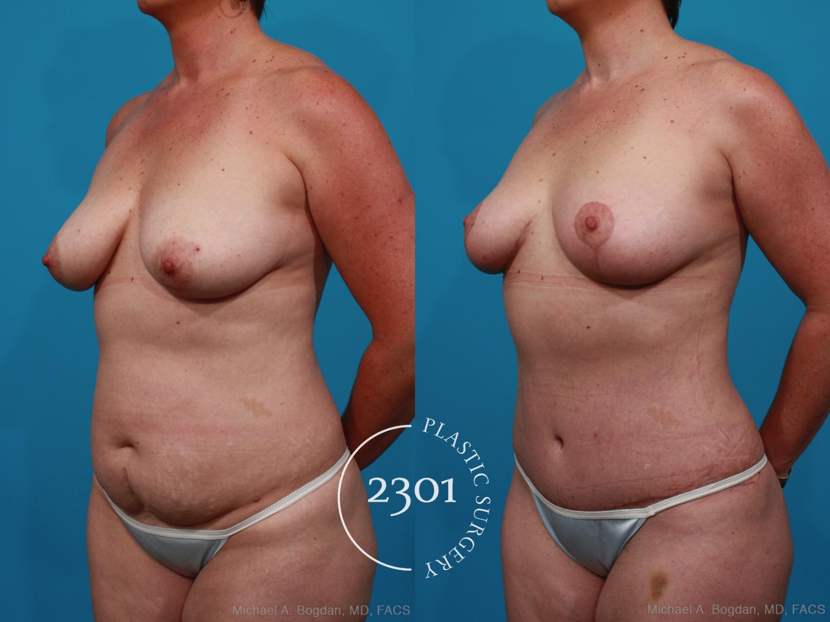 Before & After Mommy Makeover Case 266 View #3 View in Fort Worth, Plano, & Frisco, Texas