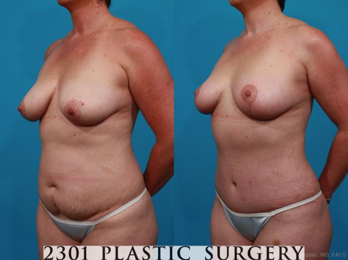 Before & After Mommy Makeover Case 266 View #3 View in Fort Worth, Plano, & Frisco, Texas