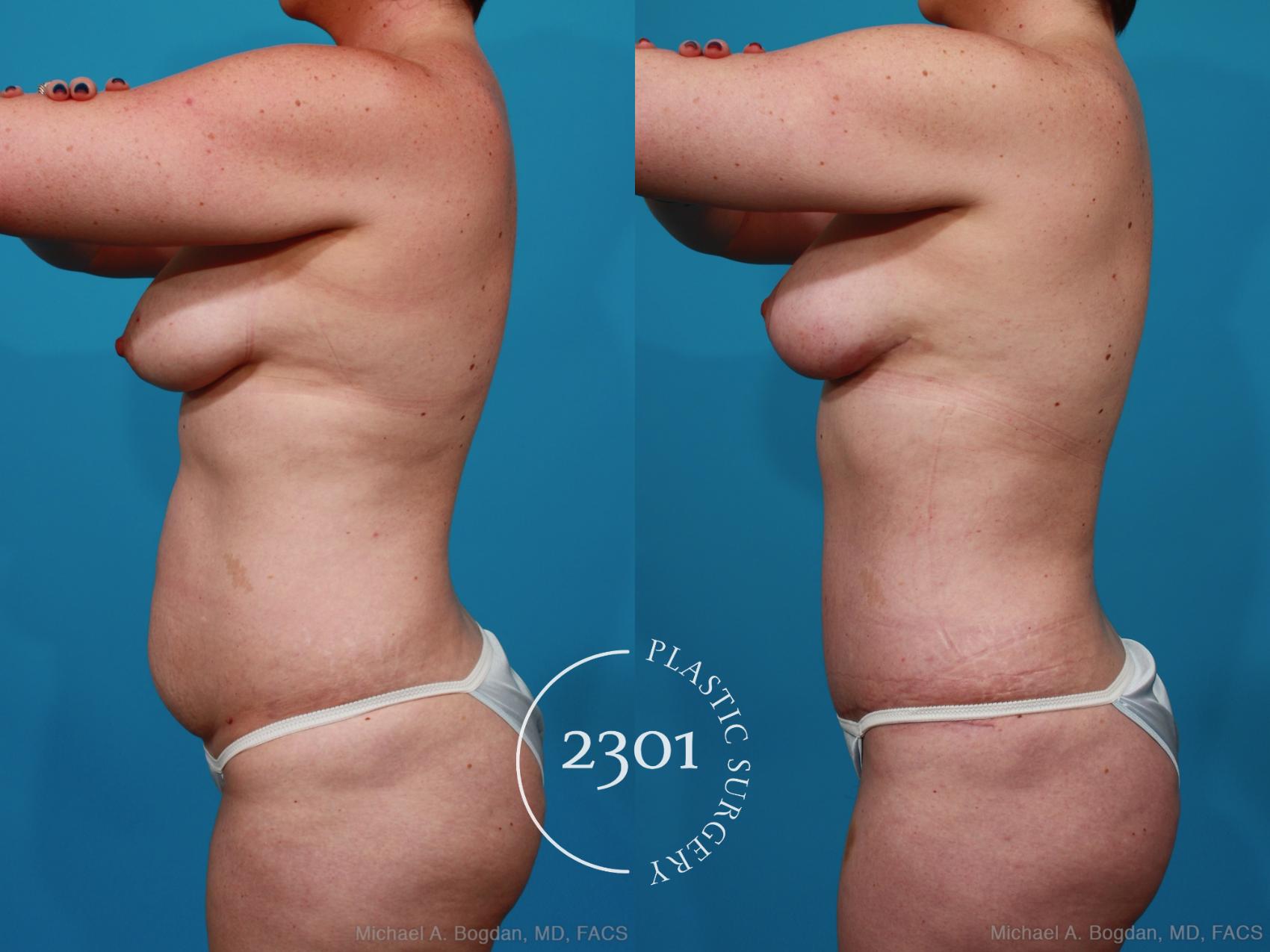 Before & After Mommy Makeover Case 266 View #4 View in Fort Worth, Plano, & Frisco, Texas