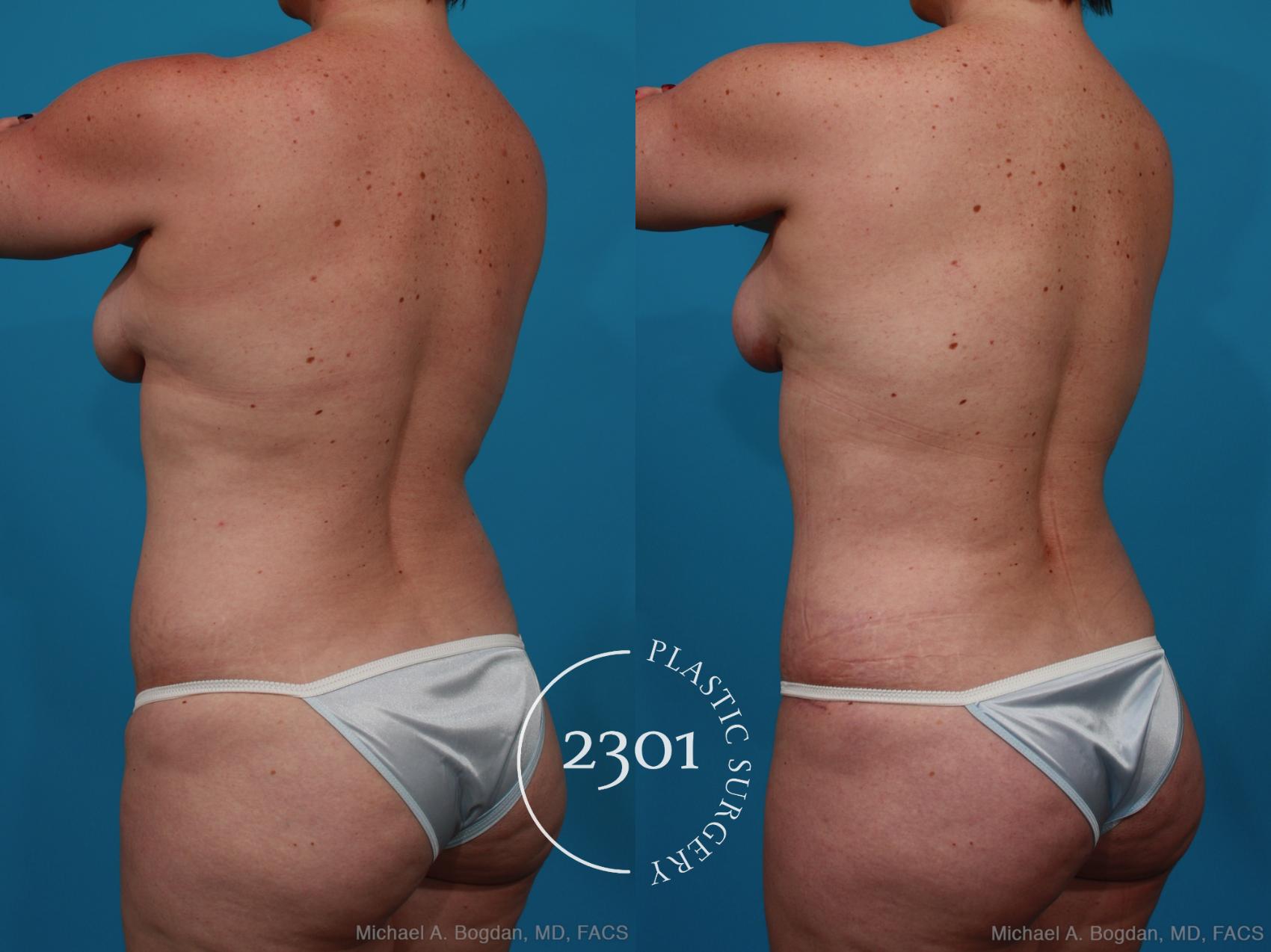 Before & After Mommy Makeover Case 266 View #5 View in Fort Worth, Plano, & Frisco, Texas