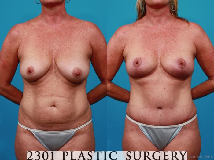 Before & After Breast Lift (Mastopexy) Case 267 View #1 View in Fort Worth, Plano, & Frisco, Texas