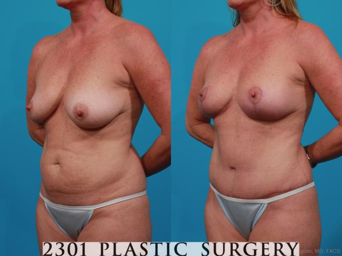 Before & After Breast Lift (Mastopexy) Case 267 View #2 View in Fort Worth, Plano, & Frisco, Texas