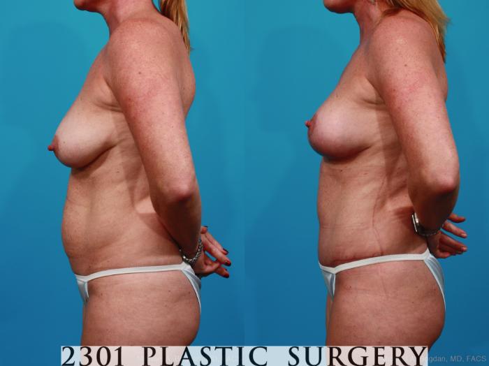 Before & After Breast Lift (Mastopexy) Case 267 View #3 View in Fort Worth, Plano, & Frisco, Texas