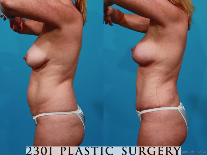 Before & After Breast Lift (Mastopexy) Case 267 View #4 View in Fort Worth, Plano, & Frisco, Texas