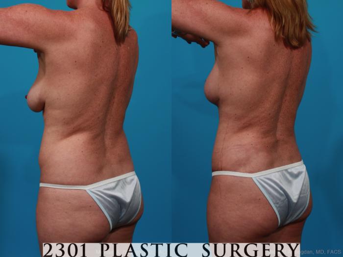 Before & After Breast Lift (Mastopexy) Case 267 View #5 View in Fort Worth, Plano, & Frisco, Texas