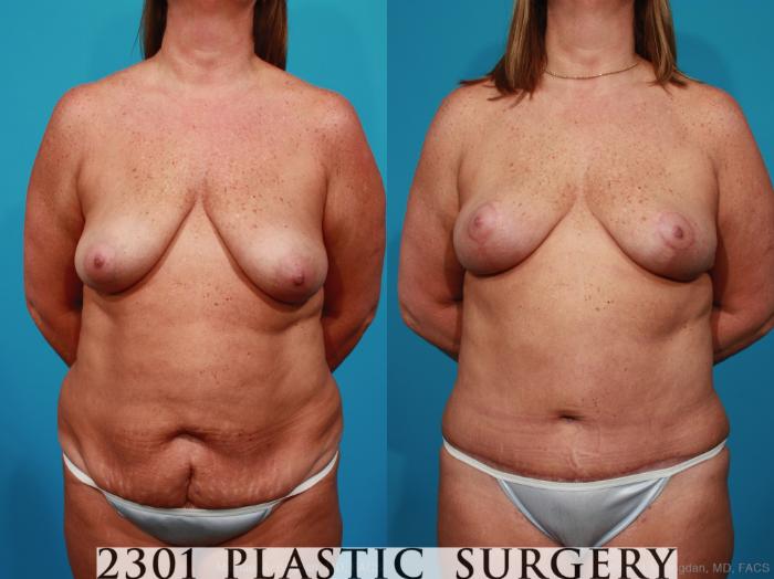 Before & After Breast Lift (Mastopexy) Case 269 View #1 View in Fort Worth, Plano, & Frisco, Texas