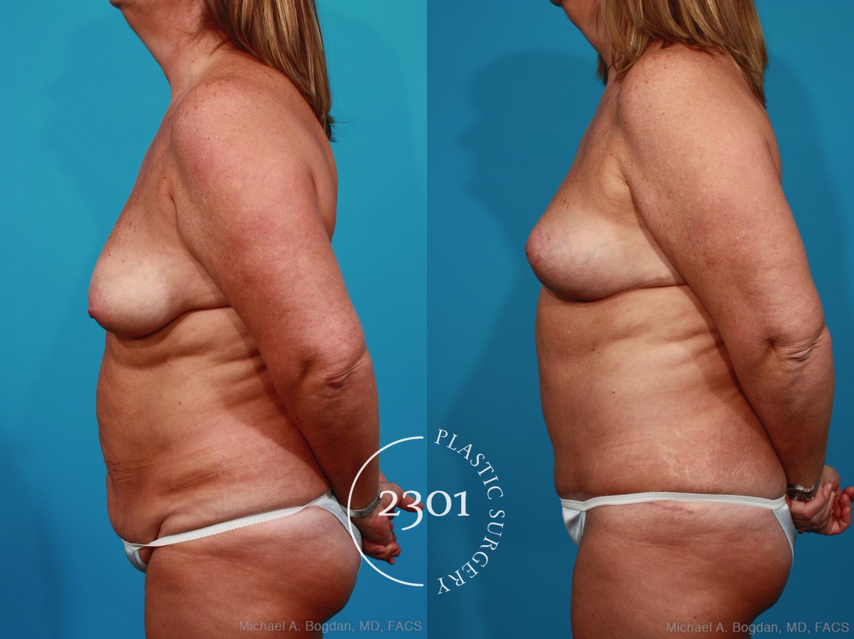 Before & After Breast Lift (Mastopexy) Case 269 View #2 View in Fort Worth, Plano, & Frisco, Texas