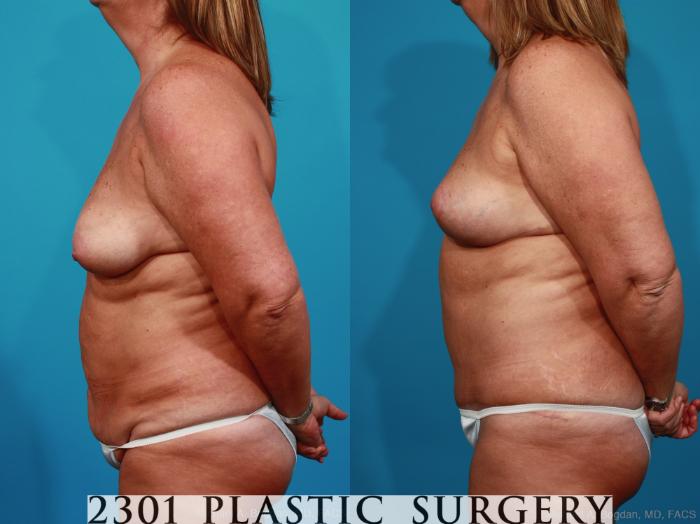 Before & After Breast Lift (Mastopexy) Case 269 View #2 View in Fort Worth, Plano, & Frisco, Texas