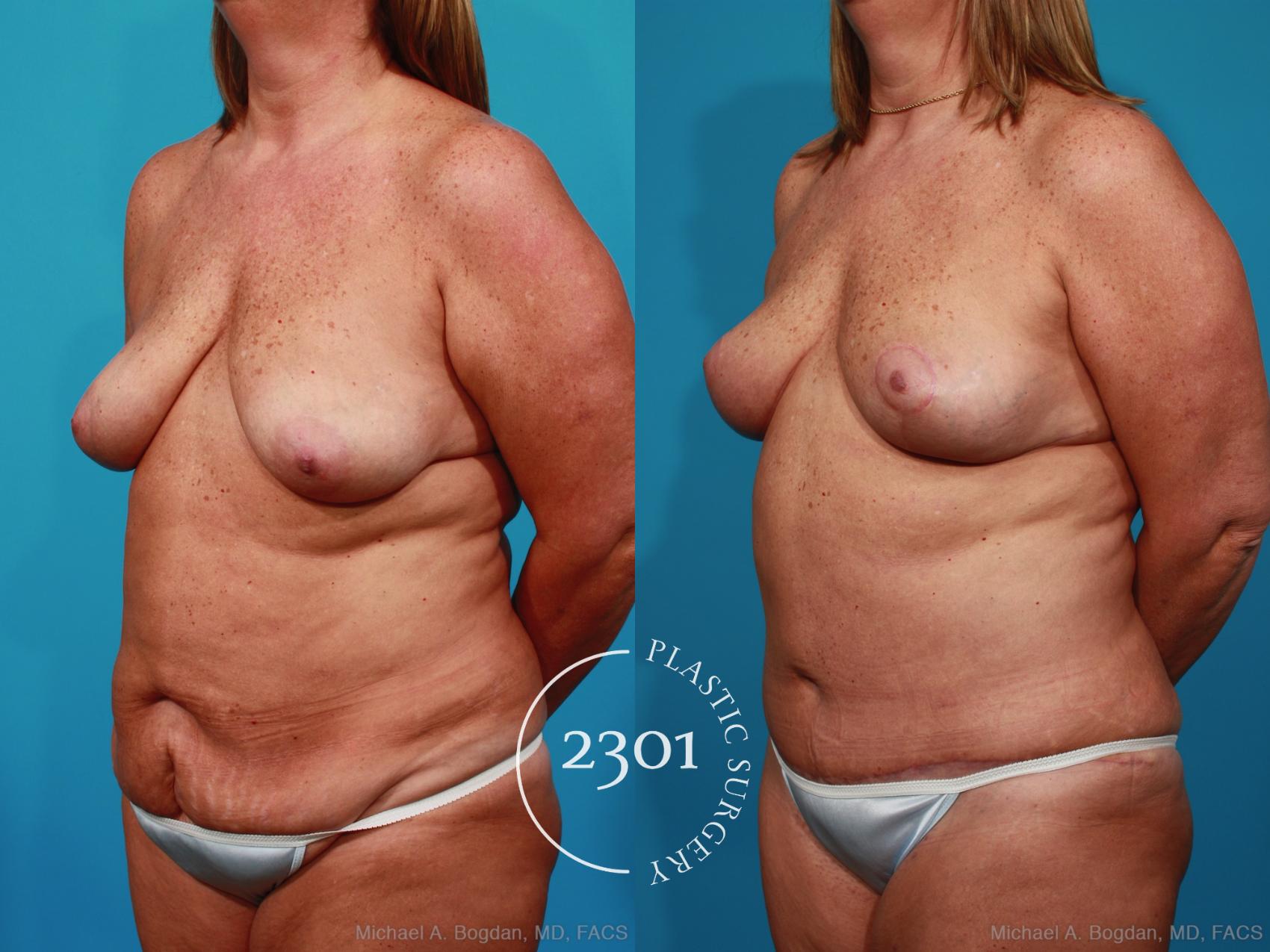 Before & After Breast Lift (Mastopexy) Case 269 View #3 View in Fort Worth, Plano, & Frisco, Texas