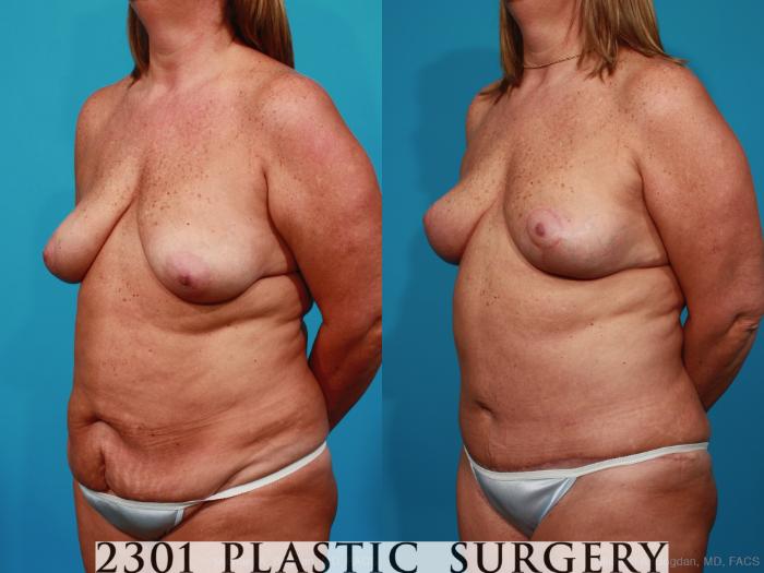 Before & After Mommy Makeover Case 269 View #3 View in Fort Worth, Plano, & Frisco, Texas