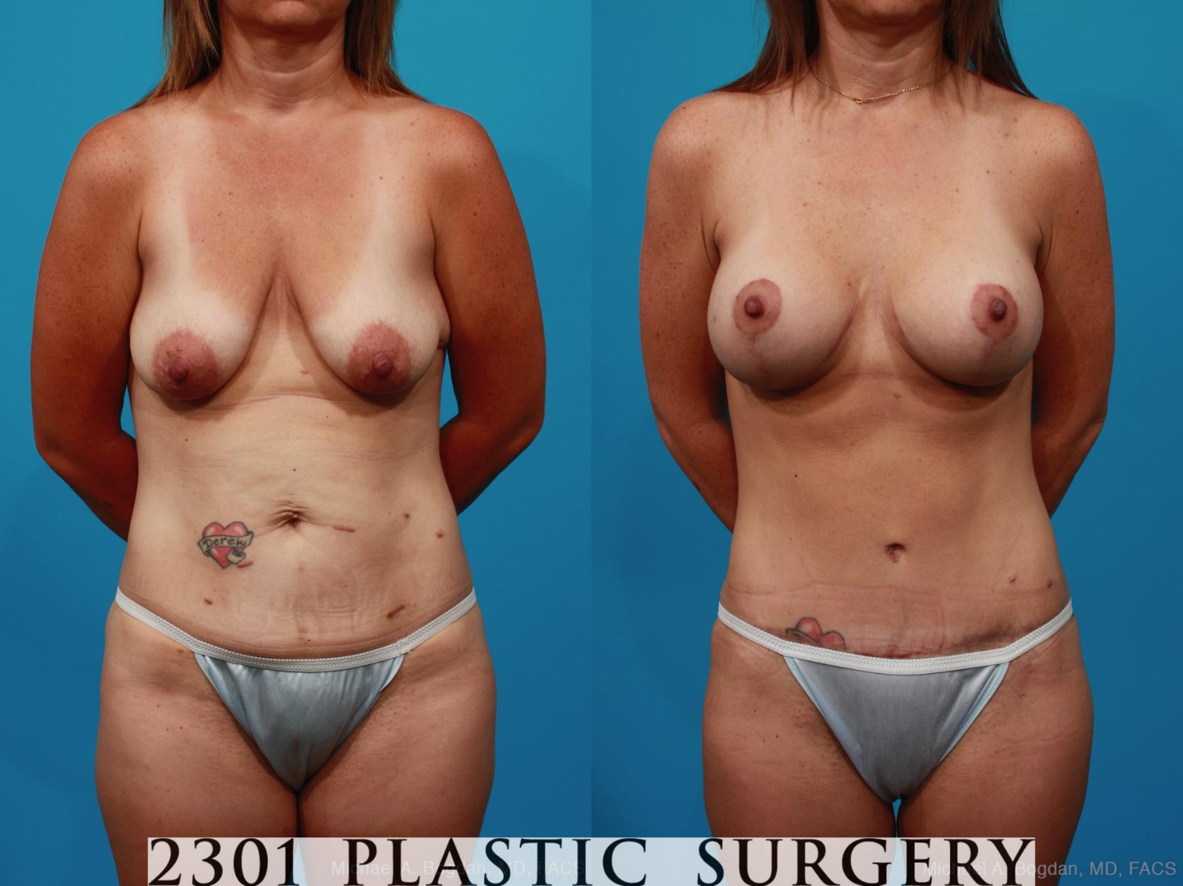 Before & After Breast Augmentation Case 272 View #1 View in Fort Worth, Plano, & Frisco, Texas