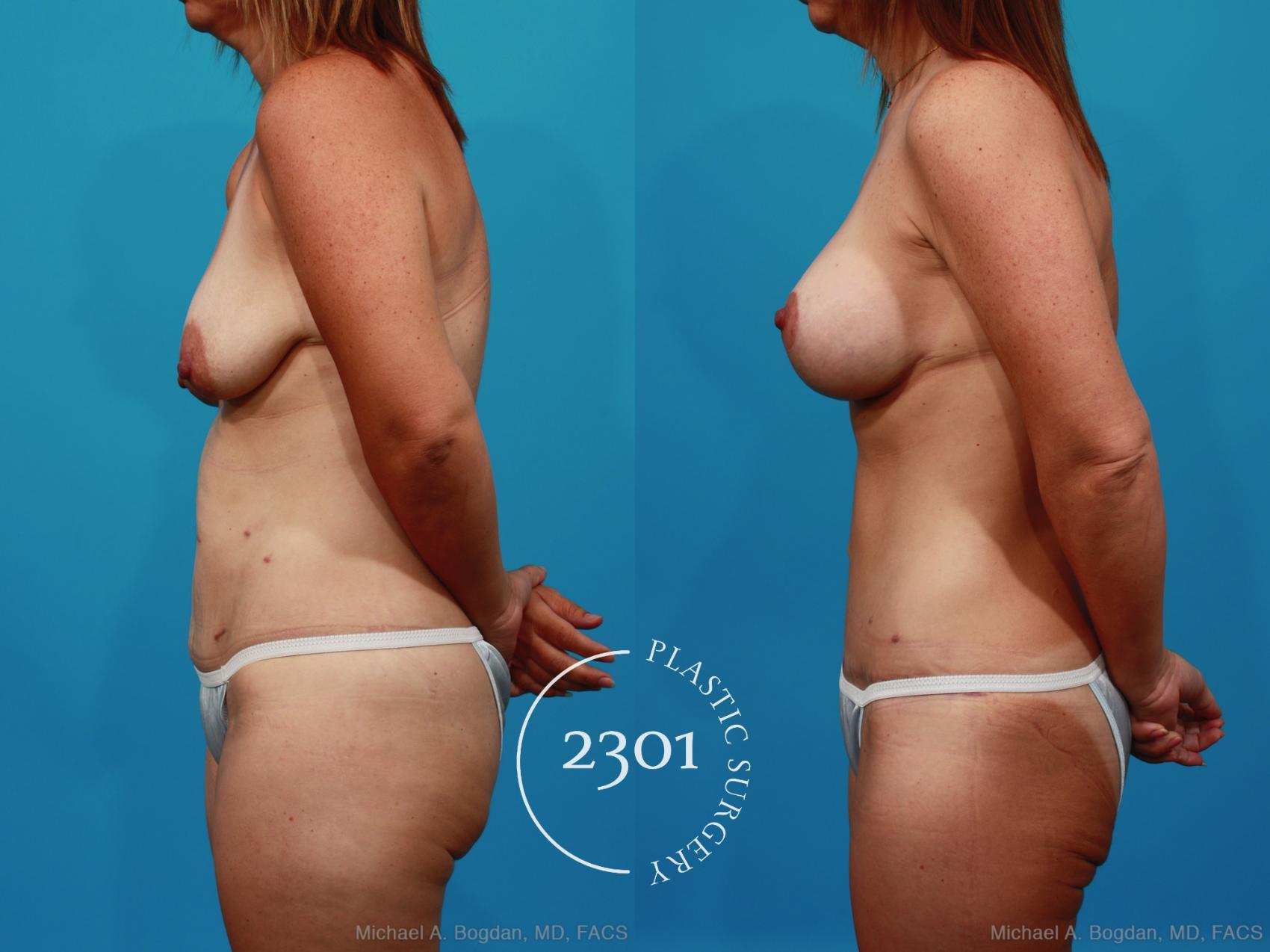 Before & After Breast Lift (Mastopexy) Case 272 View #2 View in Fort Worth, Plano, & Frisco, Texas