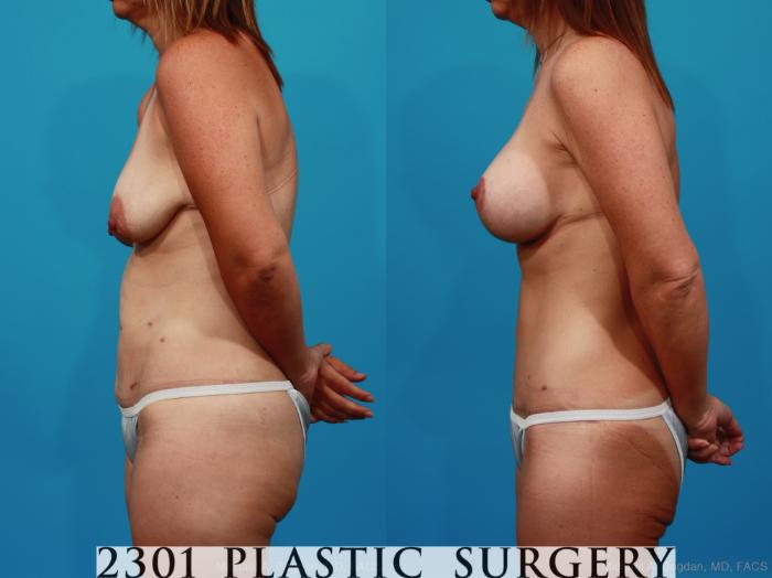 Before & After Breast Augmentation Case 272 View #2 View in Fort Worth, Plano, & Frisco, Texas