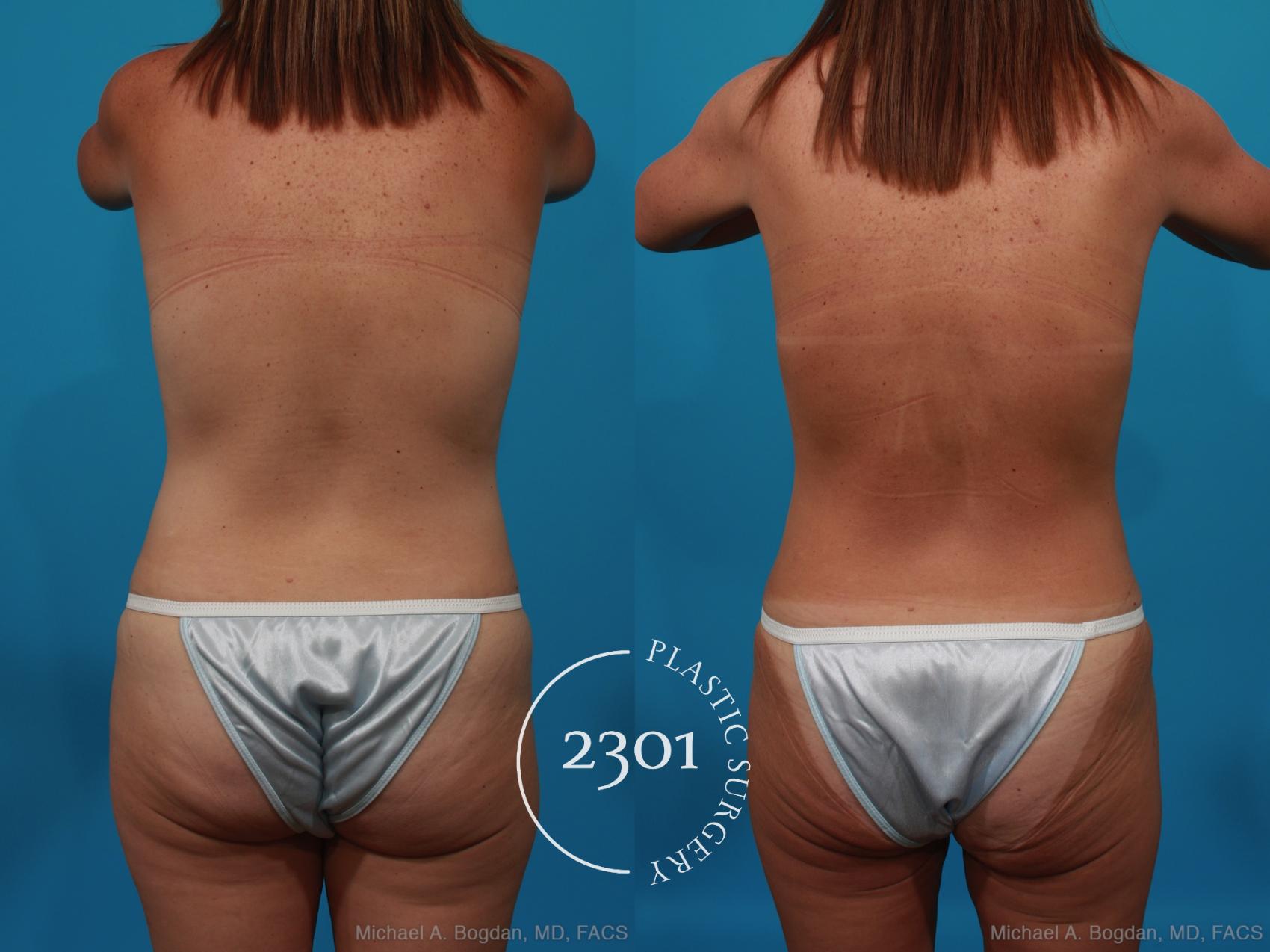 Before & After Breast Lift (Mastopexy) Case 272 View #4 View in Fort Worth, Plano, & Frisco, Texas