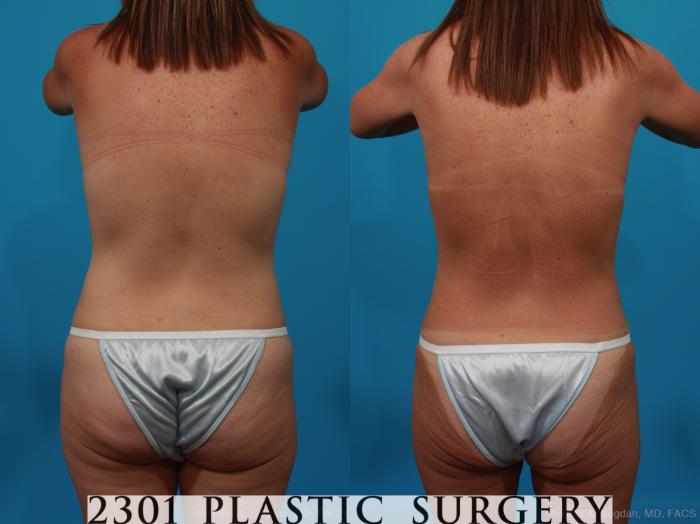 Before & After Breast Augmentation Case 272 View #4 View in Fort Worth, Plano, & Frisco, Texas