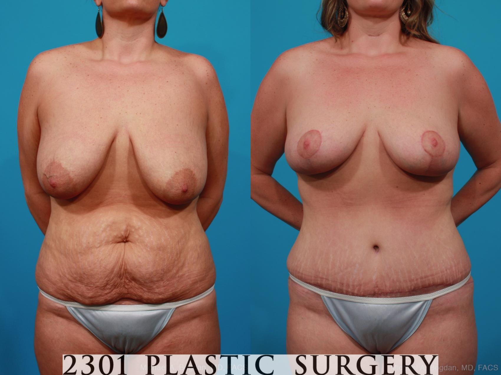 Before & After Breast Reduction Case 282 View #1 View in Fort Worth, Plano, & Frisco, Texas