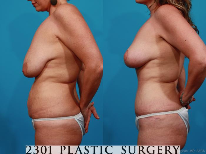 Before & After Breast Reduction Case 282 View #2 View in Fort Worth, Plano, & Frisco, Texas