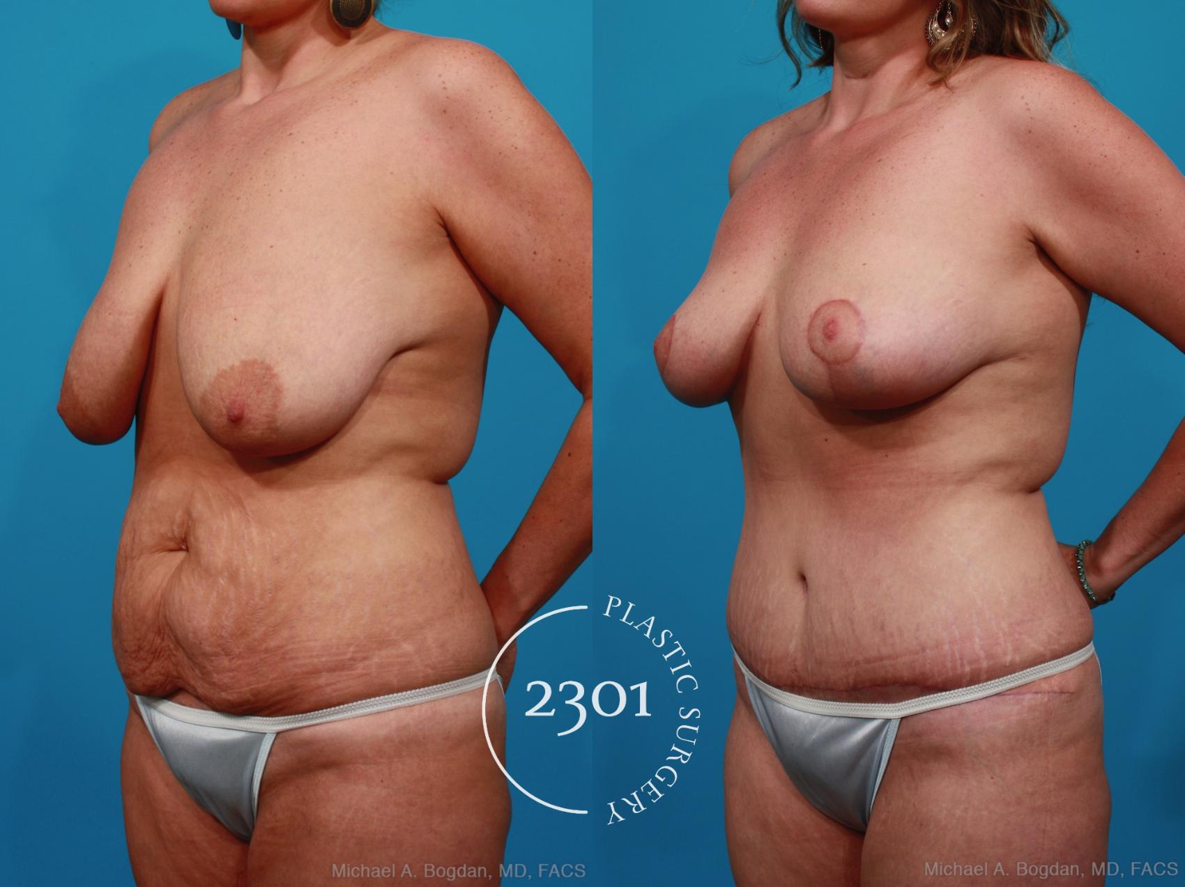 Before & After Mommy Makeover Case 282 View #3 View in Fort Worth, Plano, & Frisco, Texas